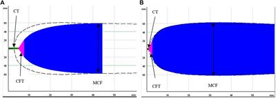 Hypothermia Induced Impairment of Platelets: Assessment With Multiplate vs. ROTEM—An In Vitro Study